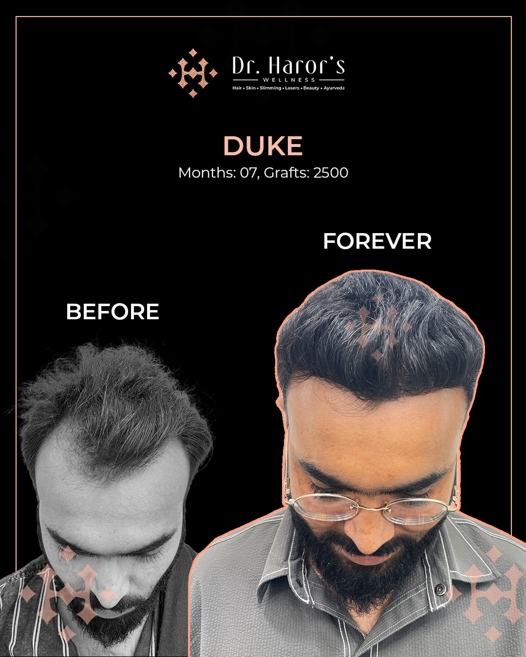 3 - Before and After